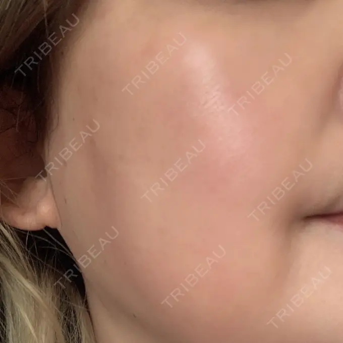 ピーリング（ニキビ・毛穴） / イオン導入 / LED治療 東京素肌クリニック 銀座本院 DAY 1 メイン用