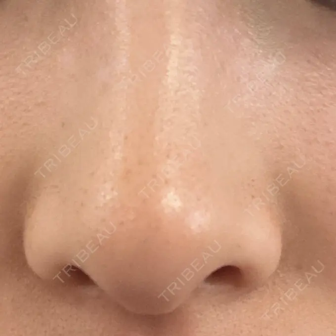 毛穴洗浄（ハイドラフェイシャルなど） BAO CLINIC 梅田院 AFTER メイン用