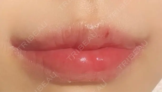 口角挙上 / その他（口元） R Beauty CLINIC 銀座院 AFTER メイン用