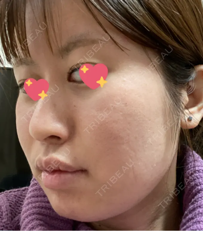 ボトックス（エラ・小顔） 新宿Ladies&Gentlemen美容クリニック DAY 0 メイン用