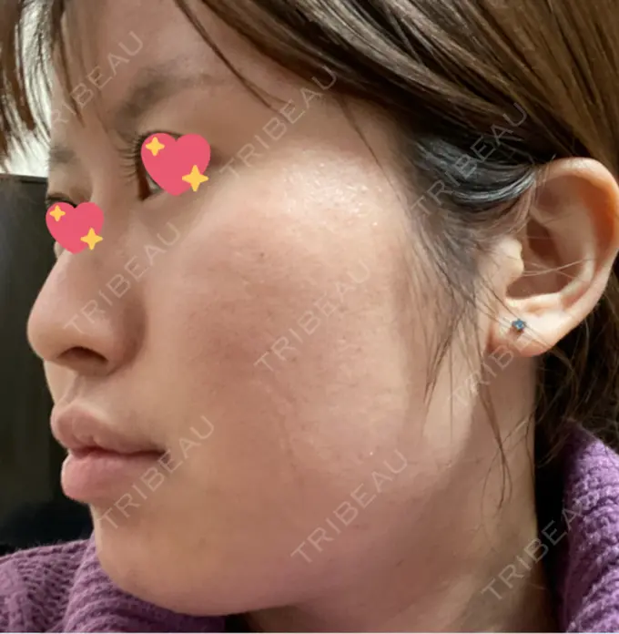 ボトックス（エラ・小顔） 新宿Ladies&Gentlemen美容クリニック DAY 0 メイン用