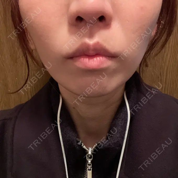人中短縮 / 口角挙上 新宿ラクル美容外科クリニック 新宿院 AFTER メイン用