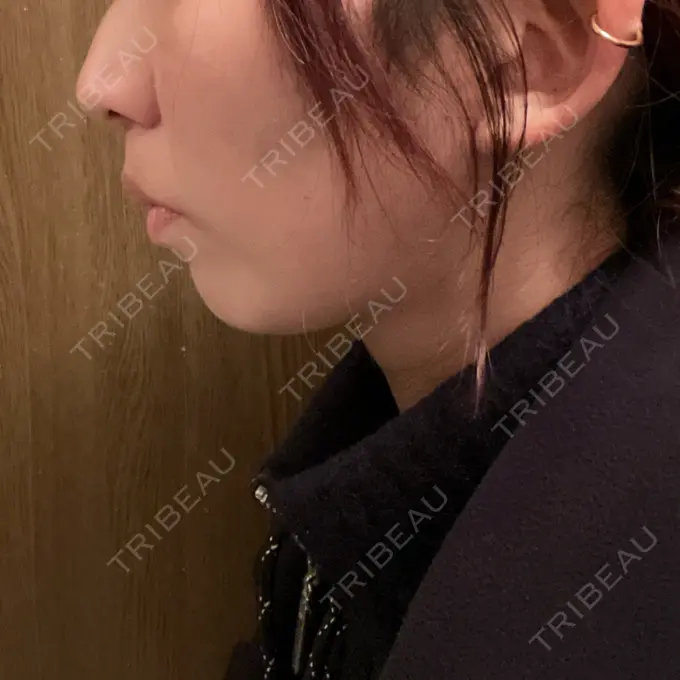 人中短縮 / 口角挙上 新宿ラクル美容外科クリニック 新宿院 DAY 117 メイン用