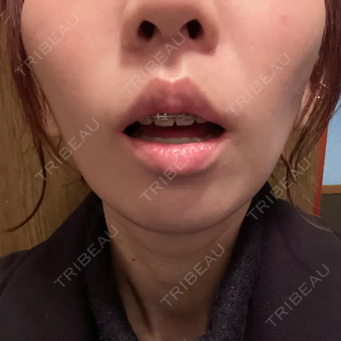 人中短縮 / 口角挙上 新宿ラクル美容外科クリニック 新宿院 DAY 117 メイン用