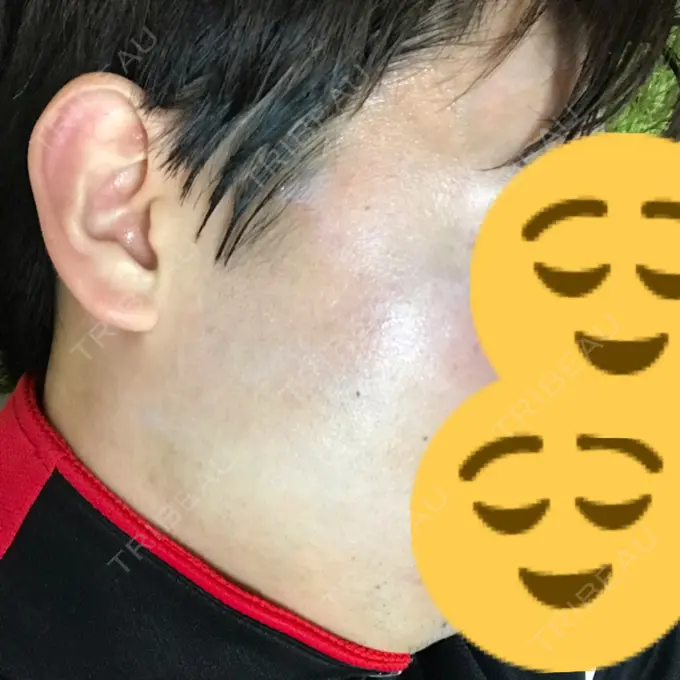 美容点滴・美容注射（美肌） / 美肌レーザー / フラクショナルレーザー（毛穴・ニキビ跡） 飯田橋駅前さくら坂クリニック DAY 6 メイン用