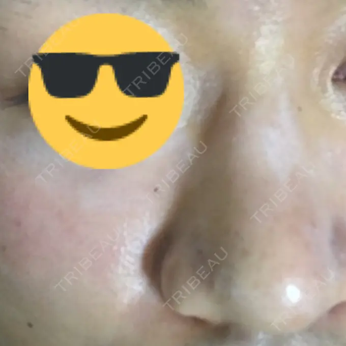 美容点滴・美容注射（美肌） / 美肌レーザー / フラクショナルレーザー（毛穴・ニキビ跡） 飯田橋駅前さくら坂クリニック DAY 6 メイン用