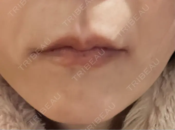 ボトックス（あご） TCB東京中央美容外科 神戸院 DAY 5 メイン用