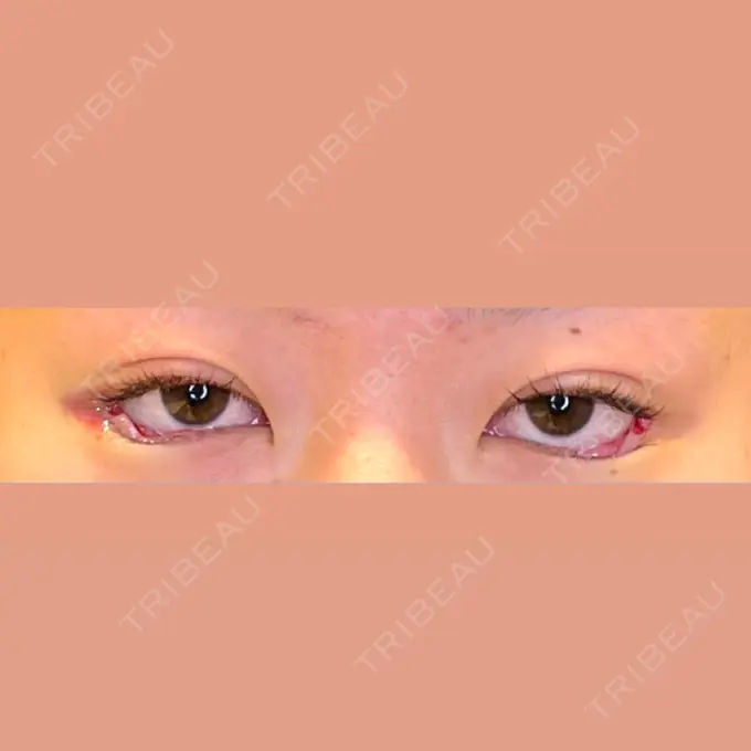 目尻切開 / タレ目形成・グラマラスライン（埋没） LOUIS CLINIC 二子玉川院【ルイクリニック】 DAY 0 メイン用