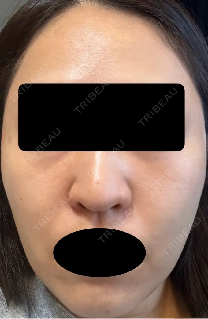 ピーリング（ハリ・ツヤ） VERDE CLINIC お茶の水（ベルデクリニックお茶の水） DAY 2 メイン用