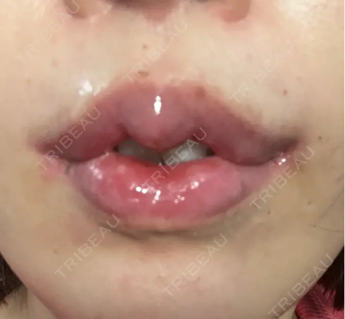 人中短縮 / 口角挙上 / その他（口元） R Beauty CLINIC 銀座院 DAY 34 メイン用