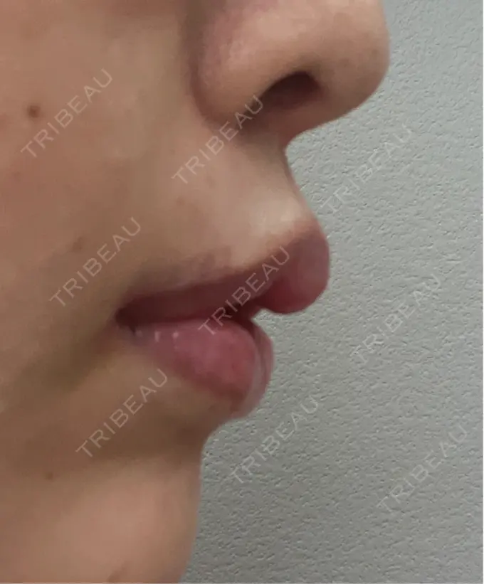 人中短縮 / 口角挙上 / その他（口元） R Beauty CLINIC 銀座院 DAY 34 メイン用