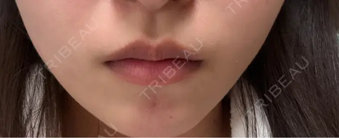 ボトックス（エラ・小顔） 共立美容外科 千葉院 DAY 25 メイン用