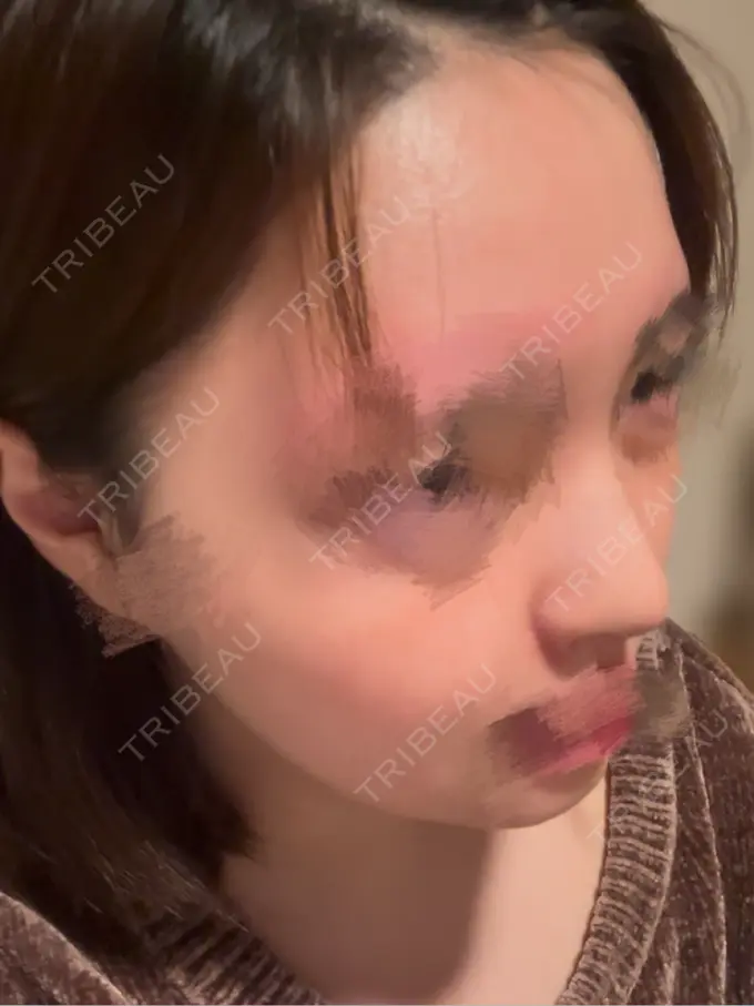 隆鼻術 / 鼻尖形成（切開） / 鼻中隔延長（切開） / 軟骨移植 / 鼻孔縁挙上 / 鼻孔縁下降 / 鼻翼基部形成（貴族手術） / その他（鼻） Designo Clinic （デジーノクリニック） DAY 14 メイン用