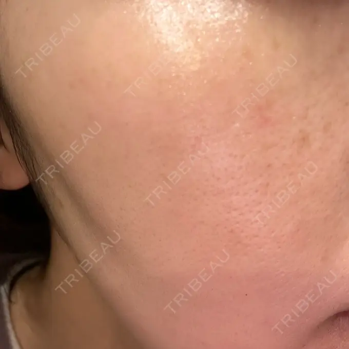 光治療（フォトフェイシャルなど） おおたかの森ビューティークリニック AFTER メイン用