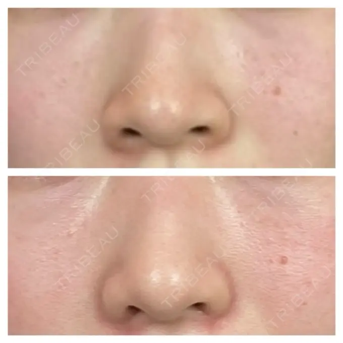 小鼻縮小（切開） 銀座S美容・形成外科クリニック DAY 71 メイン用