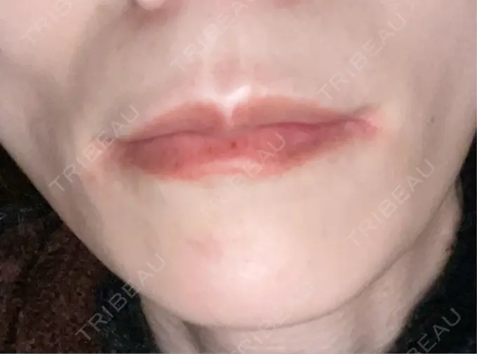 ボトックス（あご） TCB東京中央美容外科 神戸院 DAY 6 メイン用