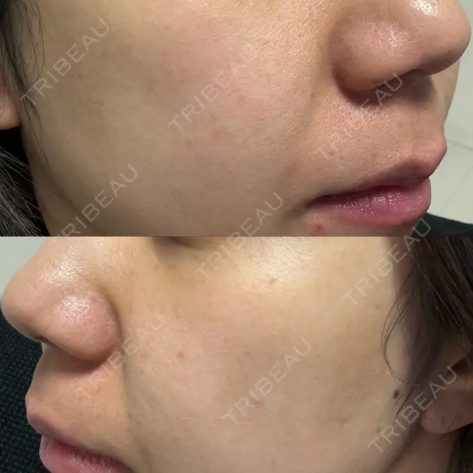 ポテンツァ ルラ美容クリニック 高田馬場院 DAY 8 メイン用