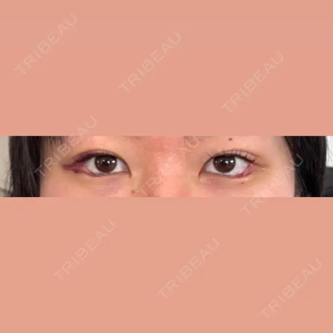 目尻切開 / タレ目形成・グラマラスライン（埋没） LOUIS CLINIC 二子玉川院【ルイクリニック】 DAY 1 メイン用