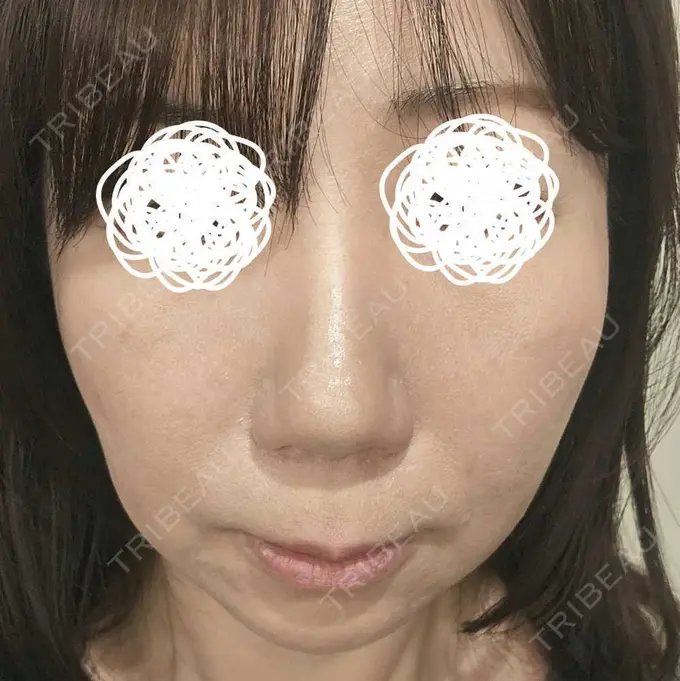 水光注射（ハリ・美肌） 筋肉・美容クリニック DAY 4 メイン用