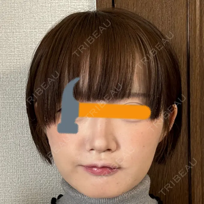 ボトックス（口角） / ヒアルロン酸注入（鼻翼基部） BiBiクリニック DAY 0 メイン用