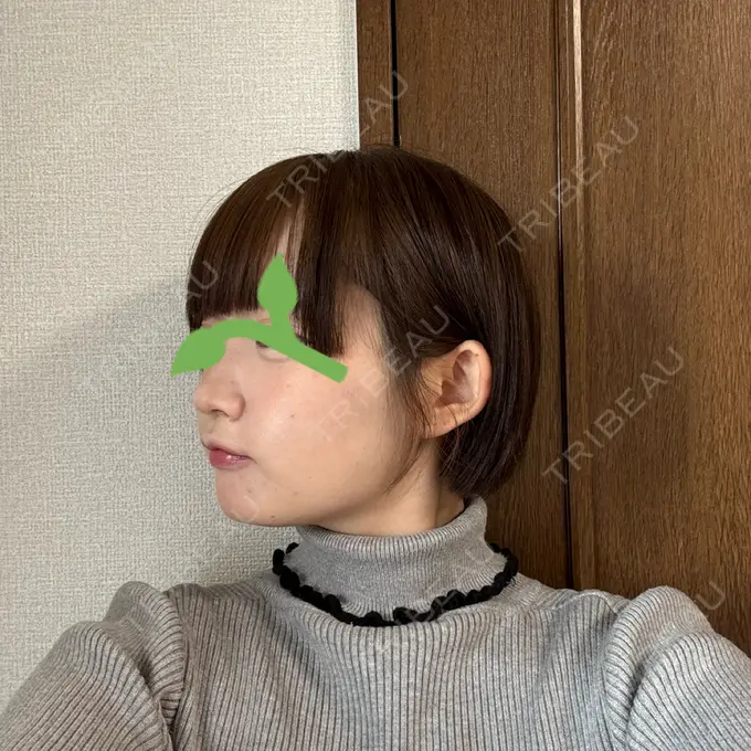 ボトックス（口角） / ヒアルロン酸注入（鼻翼基部） BiBiクリニック DAY 0 メイン用