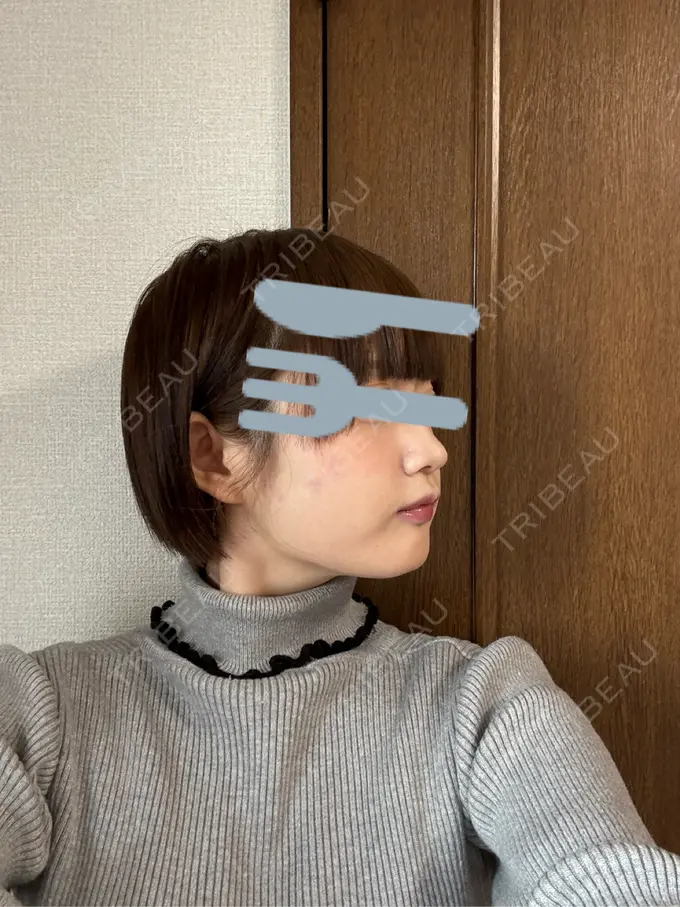 ボトックス（口角） / ヒアルロン酸注入（鼻翼基部） BiBiクリニック DAY 0 メイン用