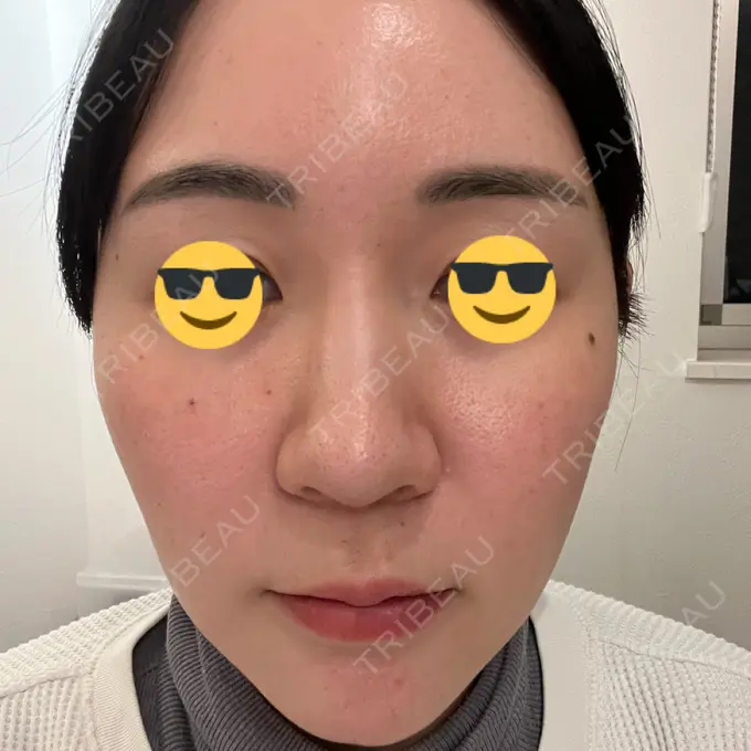 水光注射（ハリ・美肌） 韓国みにょんクリニック DAY 1 メイン用