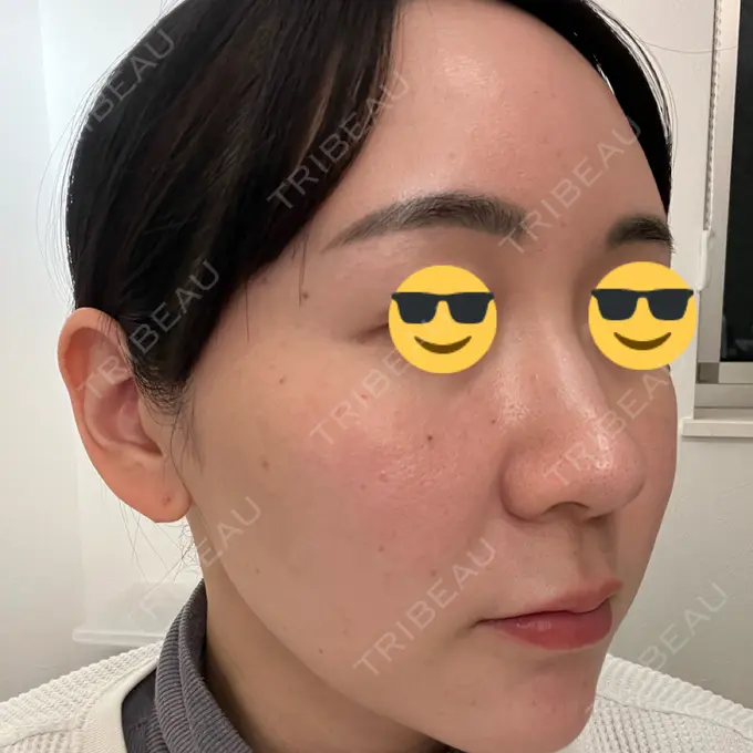 水光注射（ハリ・美肌） 韓国みにょんクリニック DAY 1 メイン用