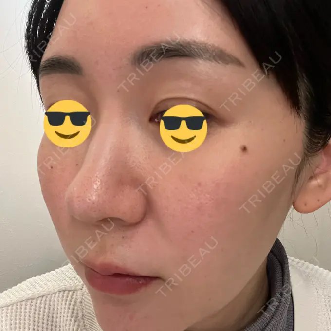 水光注射（ハリ・美肌） 韓国みにょんクリニック DAY 1 メイン用