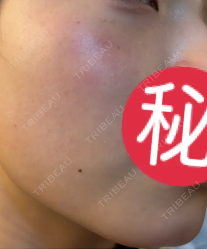 エレクトロポレーション / ルメッカ ゆきスキンクリニック 東池袋 DAY 16 メイン用