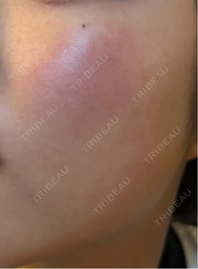 エレクトロポレーション / ルメッカ ゆきスキンクリニック 東池袋 DAY 16 メイン用