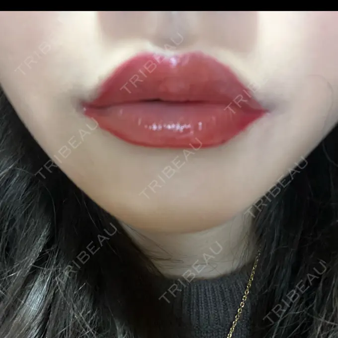 ヒアルロン酸注入（涙袋） / ボトックス（エラ・小顔） / ヒアルロン酸注入（唇） 東京シンデレラ美容外科 池袋院 AFTER メイン用