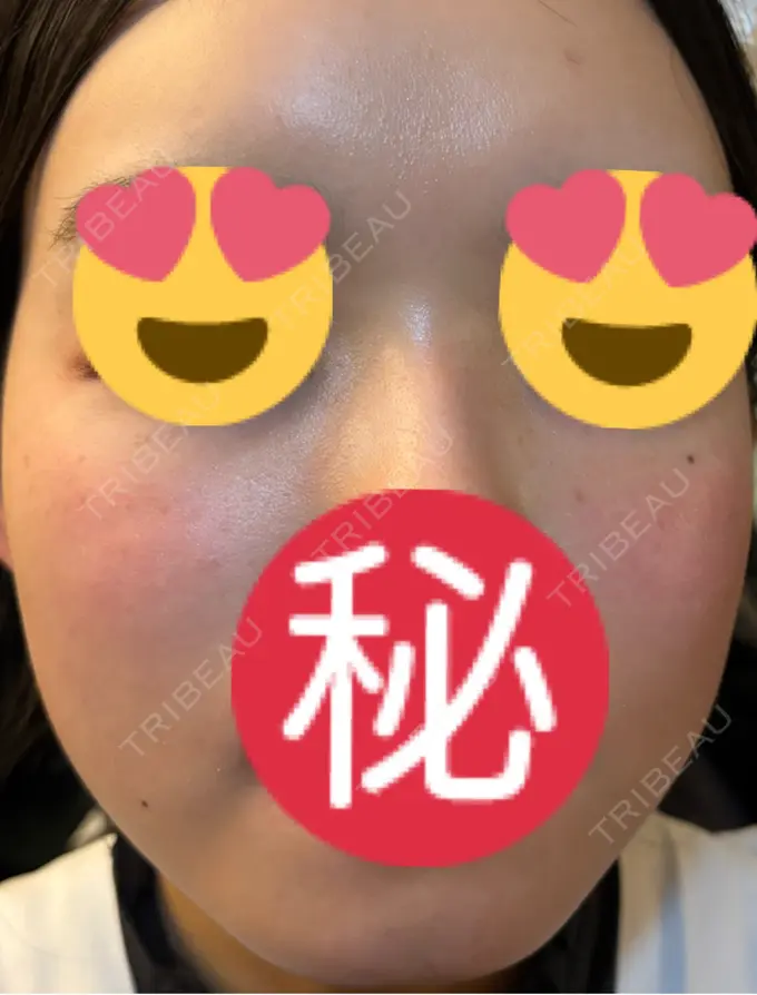 エレクトロポレーション / ルメッカ ゆきスキンクリニック 東池袋 AFTER メイン用