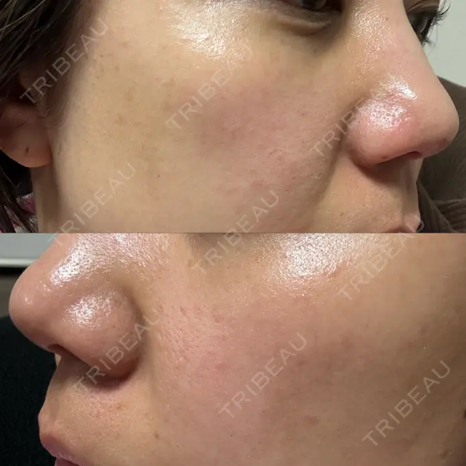 ポテンツァ ルラ美容クリニック 高田馬場院 DAY 9 メイン用