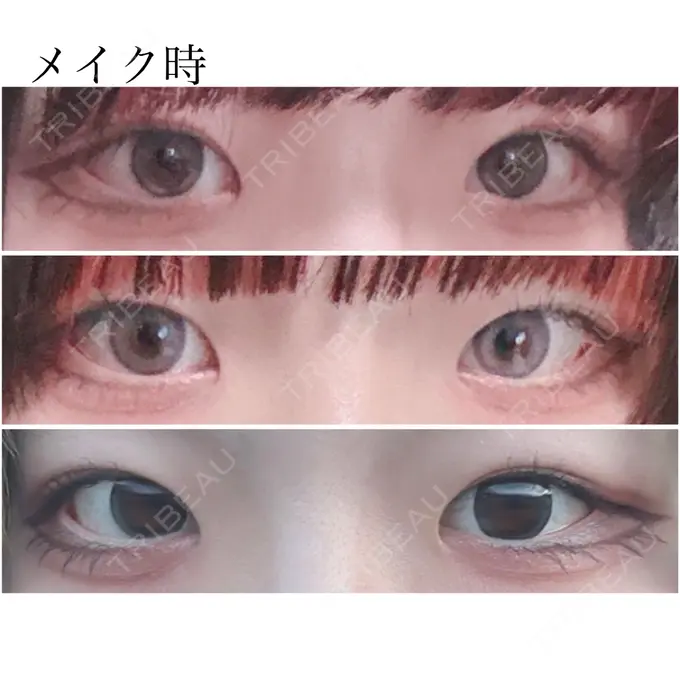 二重埋没 水の森美容クリニック 東京新宿院 DAY 1137 メイン用