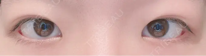 二重埋没 水の森美容クリニック 東京新宿院 AFTER メイン用