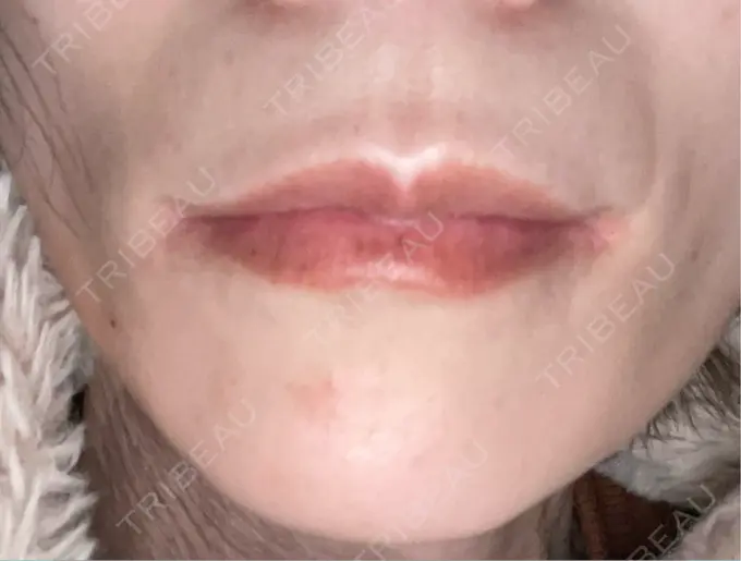 ボトックス（あご） TCB東京中央美容外科 神戸院 DAY 7 メイン用