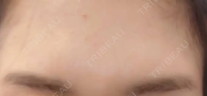 その他（肌） おおしま皮膚科 DAY 7 メイン用