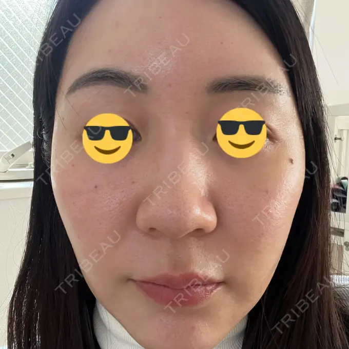 水光注射（ハリ・美肌） 韓国みにょんクリニック DAY 2 メイン用