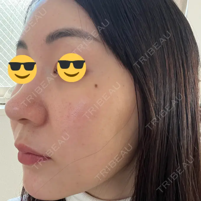 水光注射（ハリ・美肌） 韓国みにょんクリニック DAY 2 メイン用