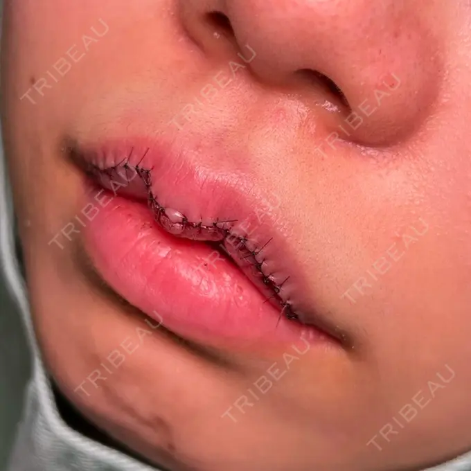 ヒアルロン酸注入（唇） / その他（口元） R Beauty CLINIC 銀座院 AFTER メイン用