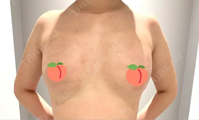 脂肪吸引（二の腕） / 脂肪吸引（脚） / 豊胸（脂肪注入） Mods Clinic（モッズクリニック） 名古屋院 DAY 33 メイン用