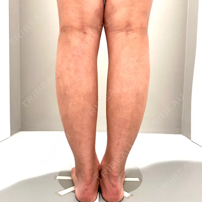 脂肪吸引（二の腕） / 脂肪吸引（脚） / 豊胸（脂肪注入） Mods Clinic（モッズクリニック） 名古屋院 DAY 33 メイン用