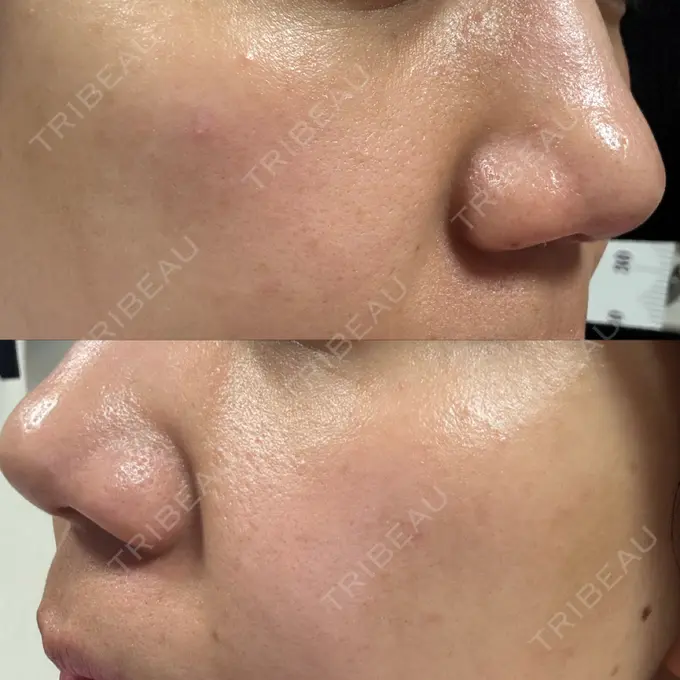 ポテンツァ ルラ美容クリニック 高田馬場院 DAY 10 メイン用