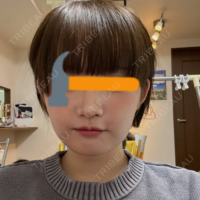 ボトックス（口角） / ヒアルロン酸注入（鼻翼基部） BiBiクリニック AFTER メイン用