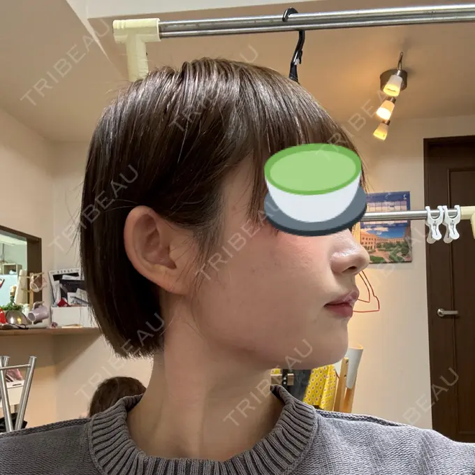 ボトックス（口角） / ヒアルロン酸注入（鼻翼基部） BiBiクリニック DAY 1 メイン用