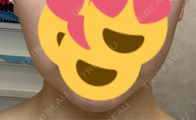 バッカルファット除去 湘南美容クリニック 博多院 AFTER メイン用