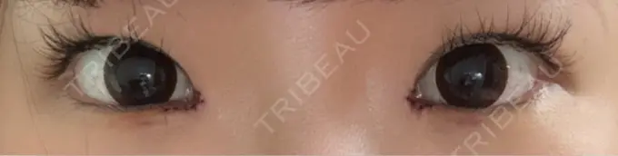 目頭切開 もとび美容外科クリニック 新宿院 DAY 3 メイン用