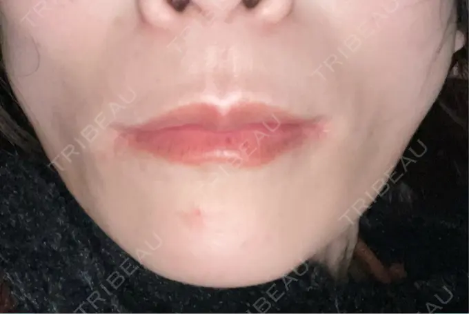 ボトックス（あご） TCB東京中央美容外科 神戸院 DAY 8 メイン用