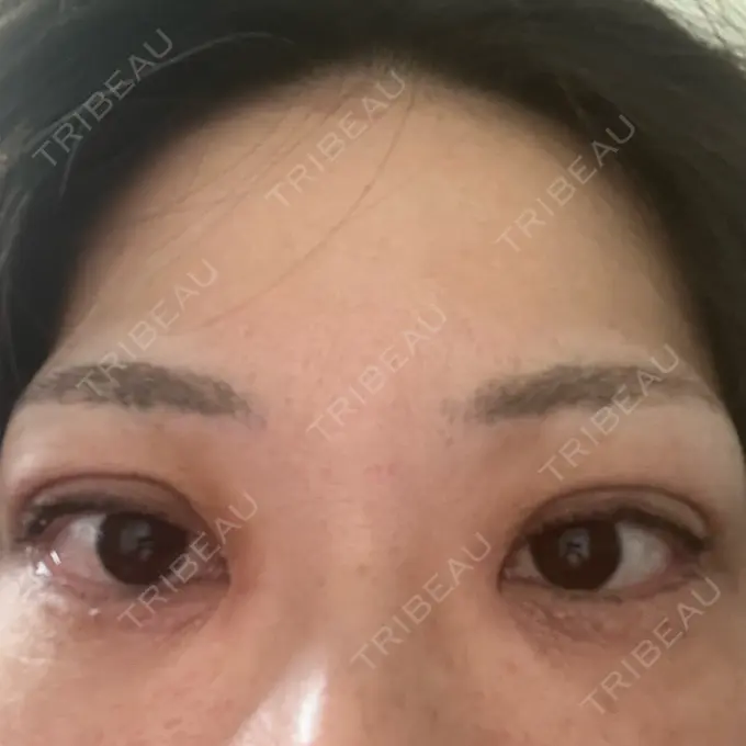 二重埋没 ネビュラクリニック 広島院 AFTER メイン用